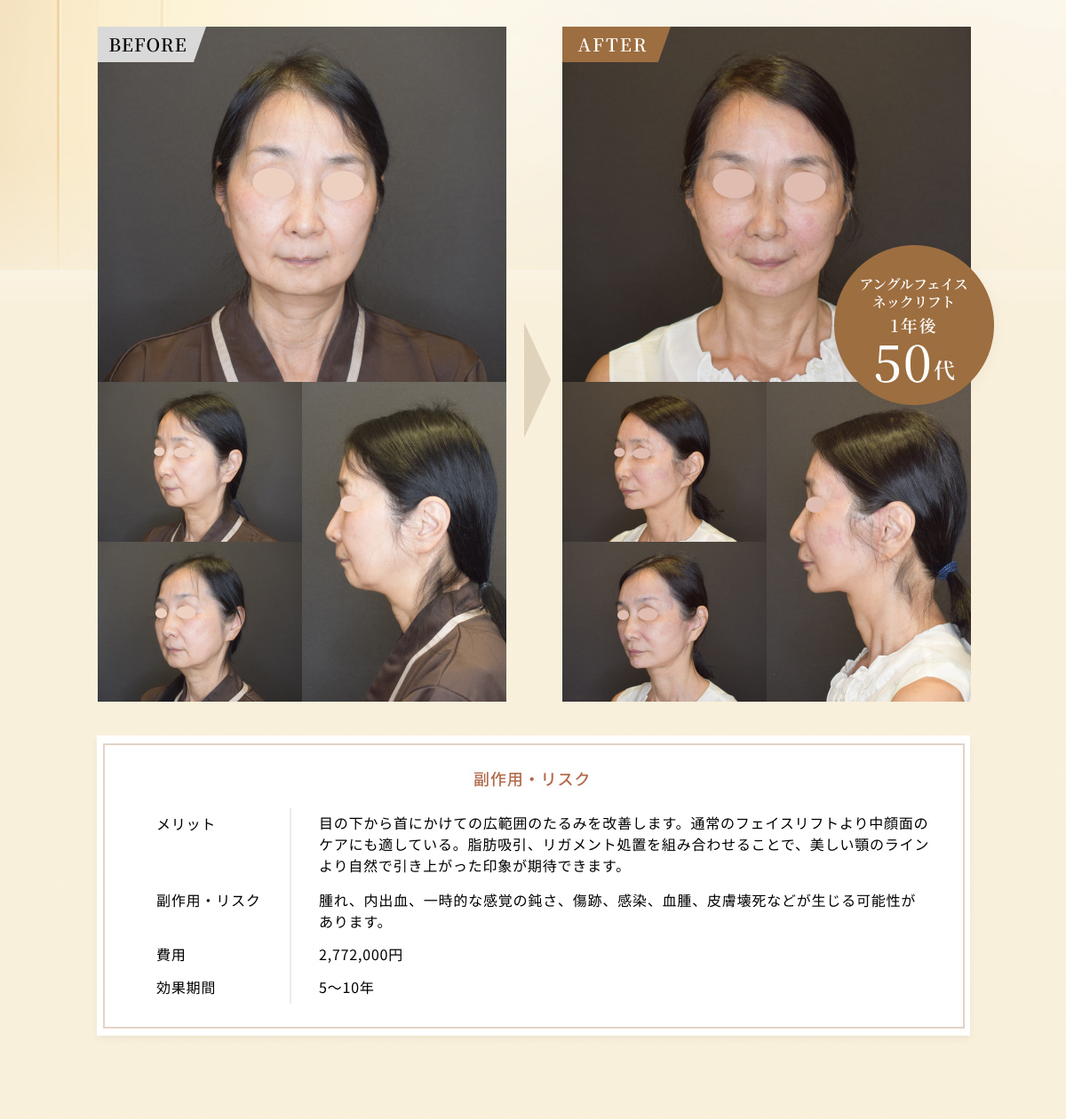 アングルフェイスネックリフト