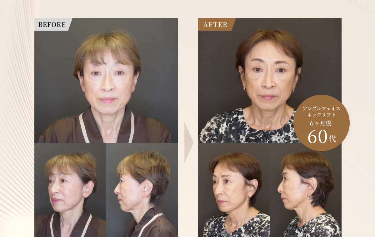 アングルフェイスネックリフト